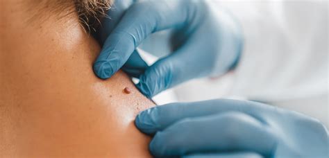 skin tags removal treatment